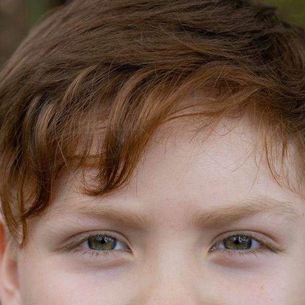 Ocular Mucous Membrane Pemphigoid (OcMMP)